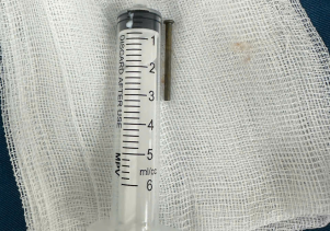 Gắp dị vật đinh sắt dài 3cm