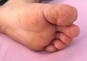 KHÔNG CHỦ QUAN VỚI MỤN CÓC LÒNG BÀN TAY, BÀN CHÂN.